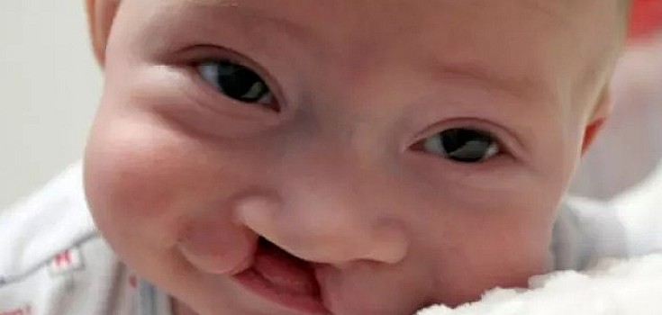Faktor Penyebab Bayi dengan Bibir Sumbing