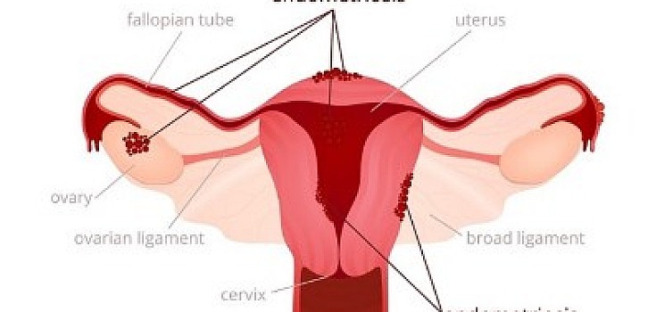 Sakit Yang Sangat Hebat Saat Menstruasi ? Waspada Endometriosis