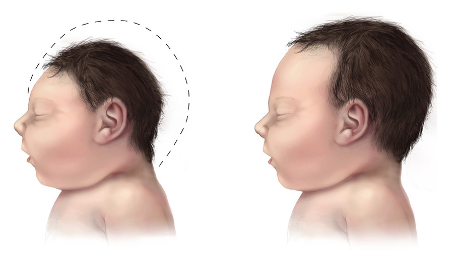 Cara Mencegah Kelahiran Bayi Dengan Mikrosefalus